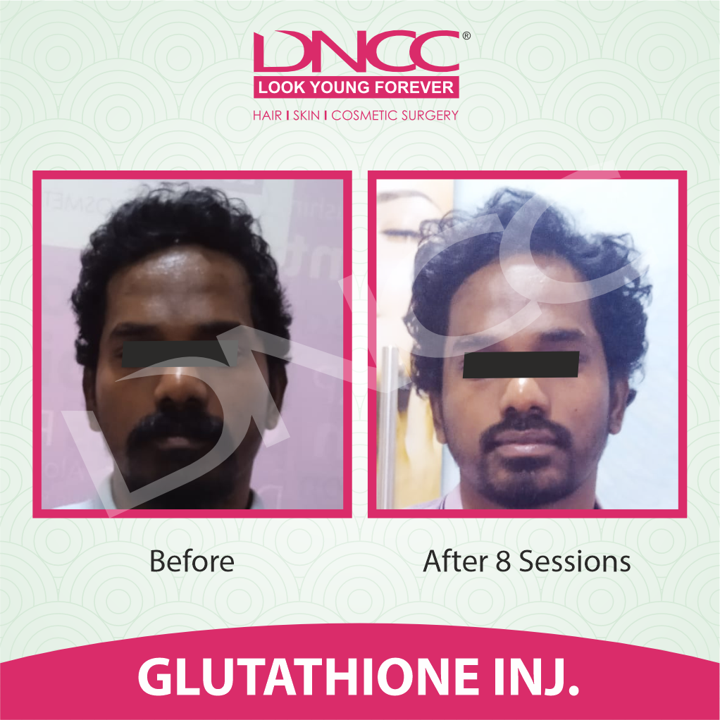 Hair Transplant Transformation 1